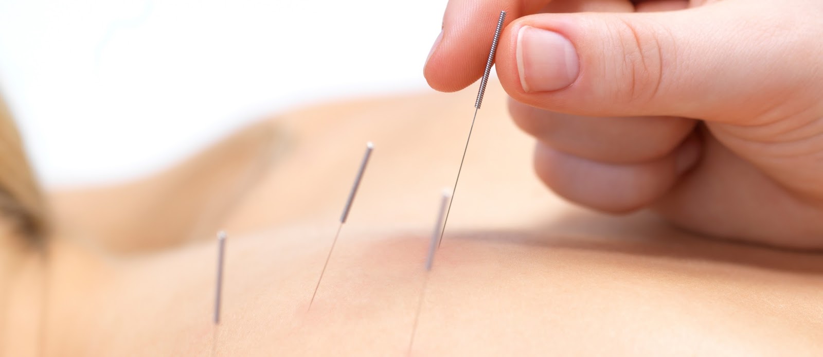 Acupuncture needles in a patient's back