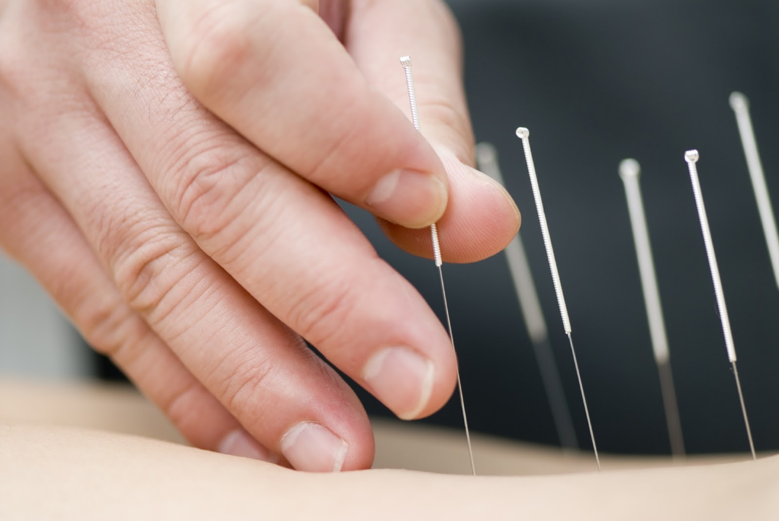 Fine needles being placed into the muscles of a back