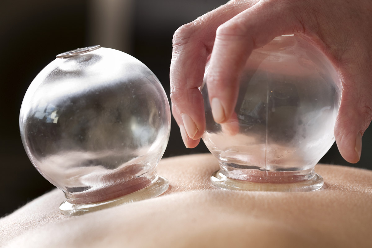 A glass cupping cup being placed on a back